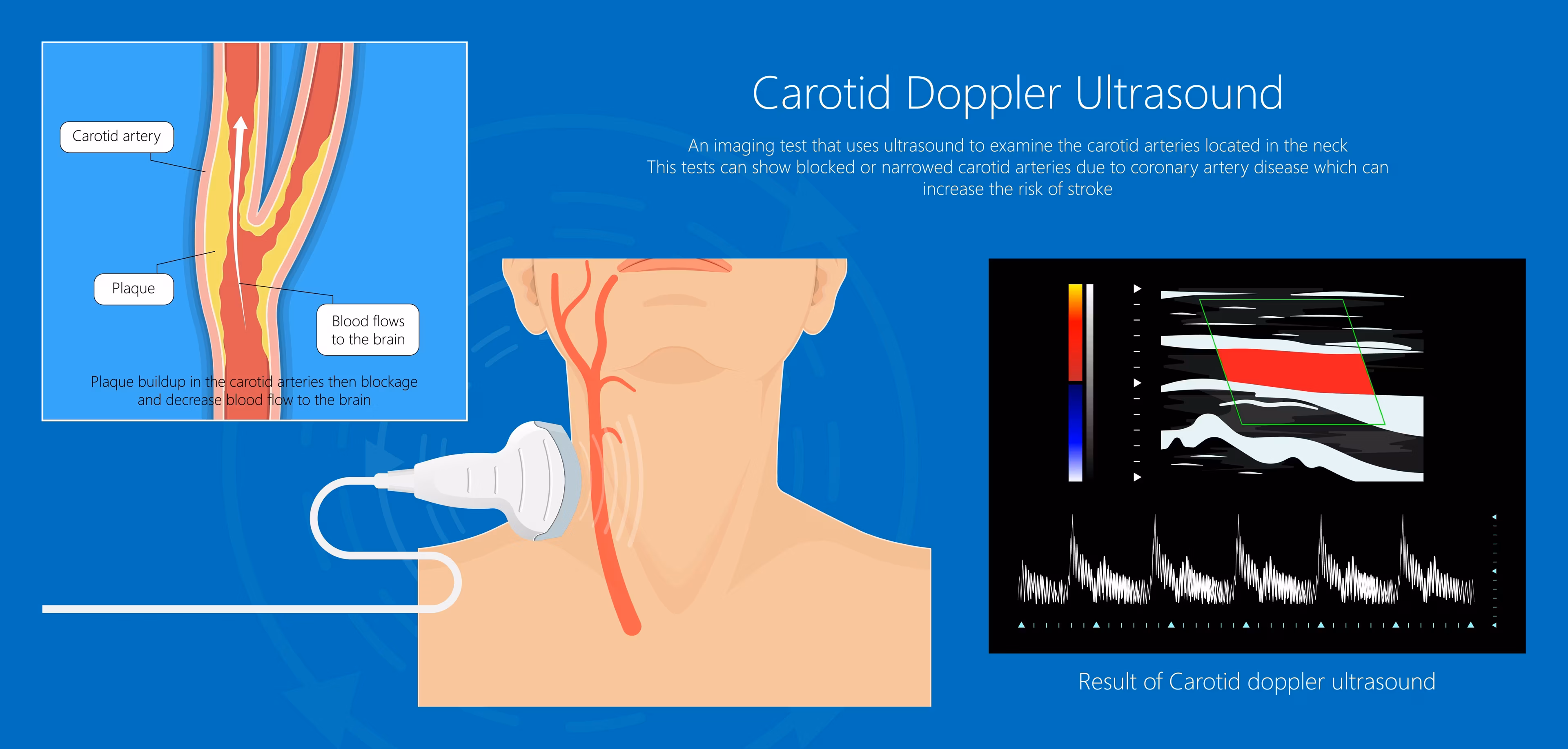 Ultrazvuk i color doppler vrata – pregled krvnih žila, štitnjače i limfnih čvorova u Zagrebu